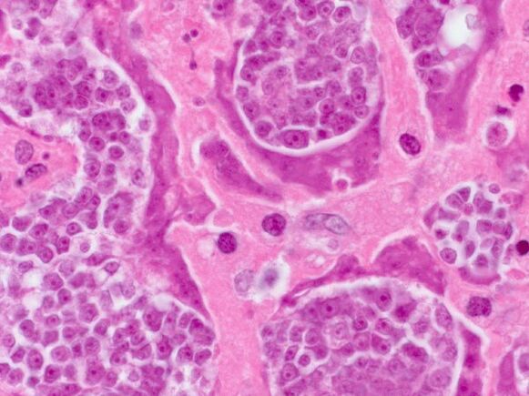 Investigación en parásitos en una persona